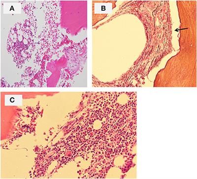 Case Report: Effects of Secondary Hyperparathyroidism Treatment on Improvement of Juvenile Nephronophthisis-Induced Pancytopenia and Myelofibrosis